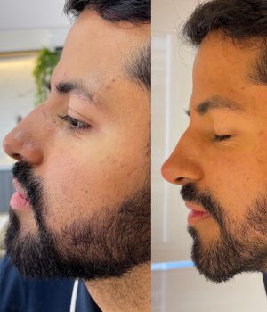 Edna Melo | Harmonização Facial e estética em Águas Claras | Brasília DF