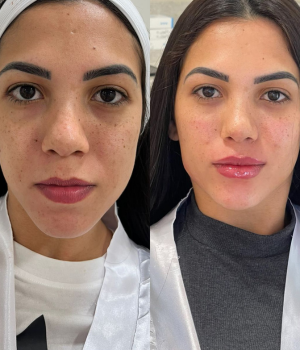 Edna Melo | Harmonização Facial e estética em Águas Claras | Brasília DF